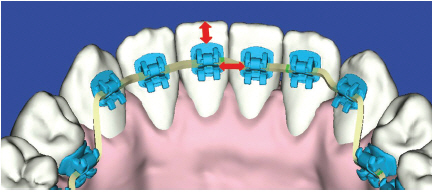 Lingual Bracket Placement Simulation